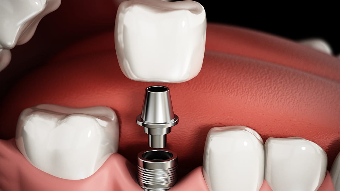 Dental implant 