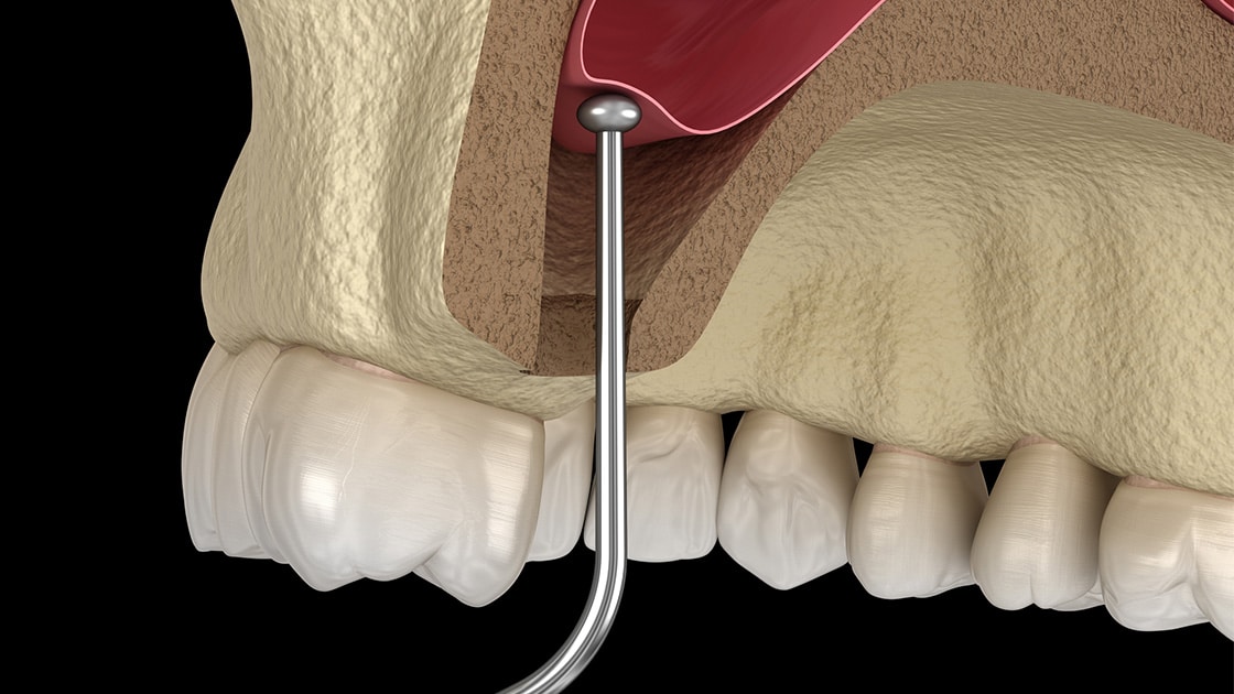 Sinus lift